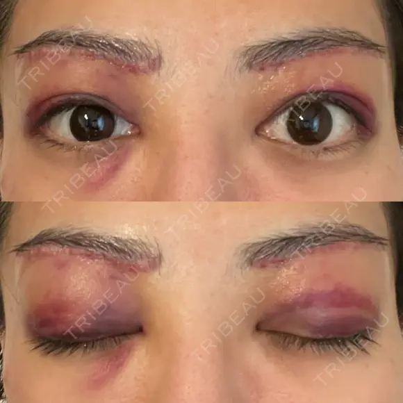 眉下切開 e:Top clinic（イートップクリニック） DAY 2 メイン用