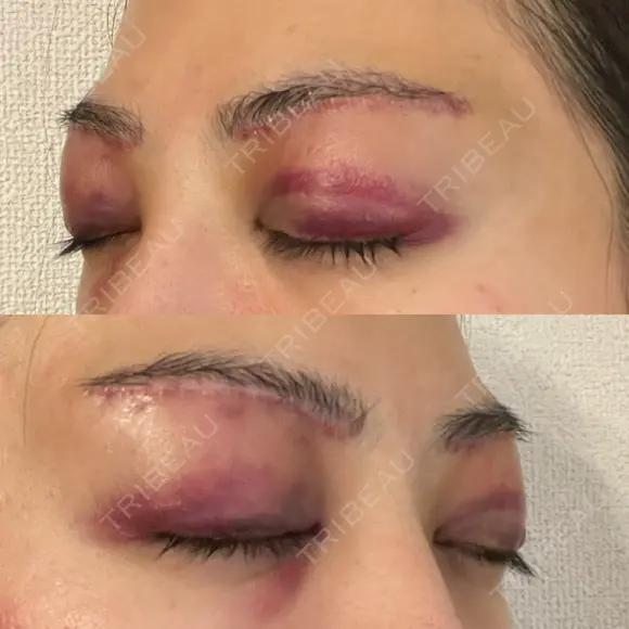 眉下切開 e:Top clinic（イートップクリニック） DAY 2 メイン用