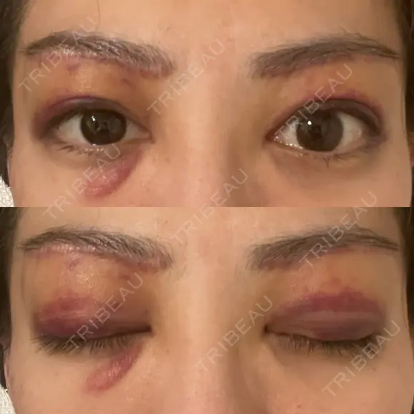 眉下切開 e:Top clinic（イートップクリニック） DAY 2 メイン用