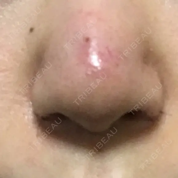 鼻尖形成（切開） / 小鼻縮小（切開） / 軟骨移植 牧野皮膚科医院 DAY 6 メイン用