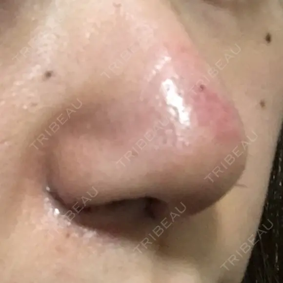 鼻尖形成（切開） / 小鼻縮小（切開） / 軟骨移植 牧野皮膚科医院 DAY 6 メイン用