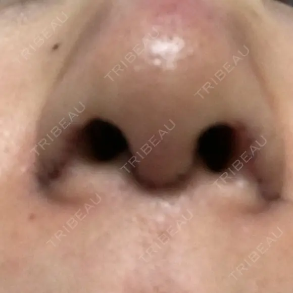 鼻尖形成（切開） / 小鼻縮小（切開） / 軟骨移植 牧野皮膚科医院 DAY 6 メイン用