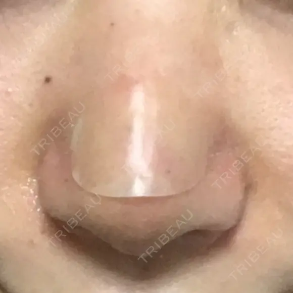 鼻尖形成（切開） / 小鼻縮小（切開） / 軟骨移植 牧野皮膚科医院 DAY 7 メイン用