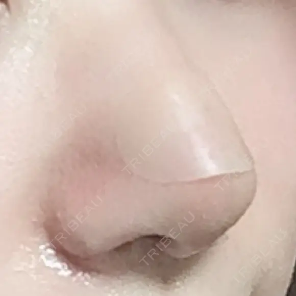 鼻尖形成（切開） / 小鼻縮小（切開） / 軟骨移植 牧野皮膚科医院 DAY 7 メイン用