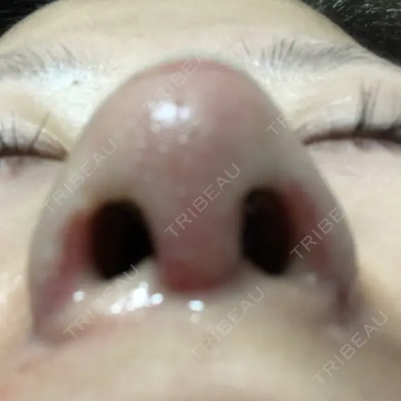 鼻尖形成（切開） / 小鼻縮小（切開） / 軟骨移植 牧野皮膚科医院 DAY 7 メイン用