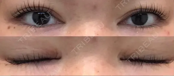 二重切開 松下皮フ形成外科 AFTER メイン用