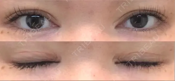 二重切開 松下皮フ形成外科 DAY 63 メイン用