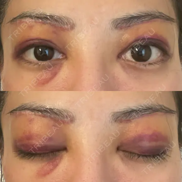 眉下切開 e:Top clinic（イートップクリニック） DAY 3 メイン用