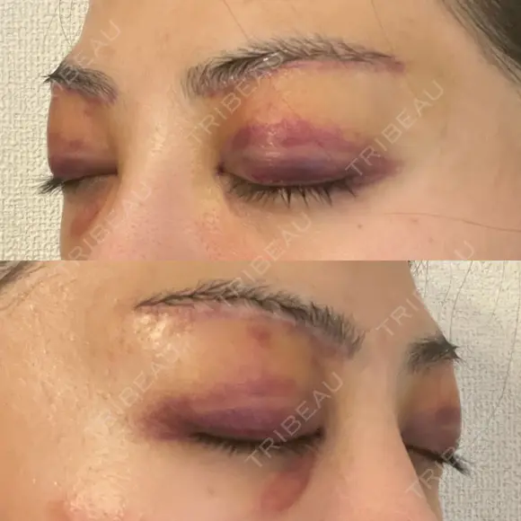 眉下切開 e:Top clinic（イートップクリニック） DAY 3 メイン用