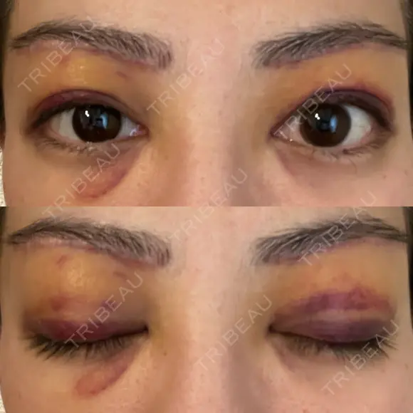 眉下切開 e:Top clinic（イートップクリニック） AFTER メイン用