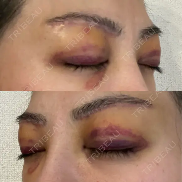 眉下切開 e:Top clinic（イートップクリニック） DAY 4 メイン用