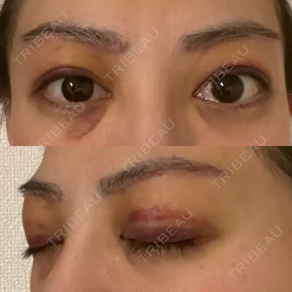 眉下切開 e:Top clinic（イートップクリニック） DAY 4 メイン用