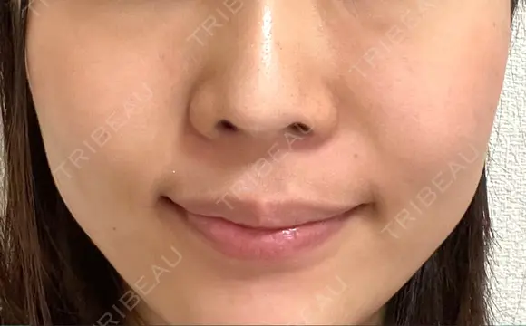 人中短縮 / その他（口元） レナトゥスクリニック 東京田町院 DAY 3 メイン用