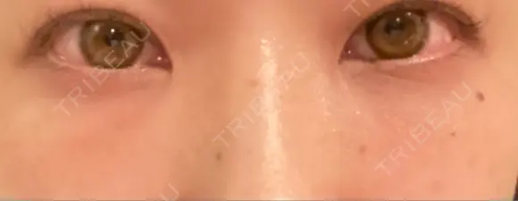 クマ治療 / 下まぶたの脂肪取り / 脂肪注入（肌） X CLINIC 大阪院 DAY 23 メイン用