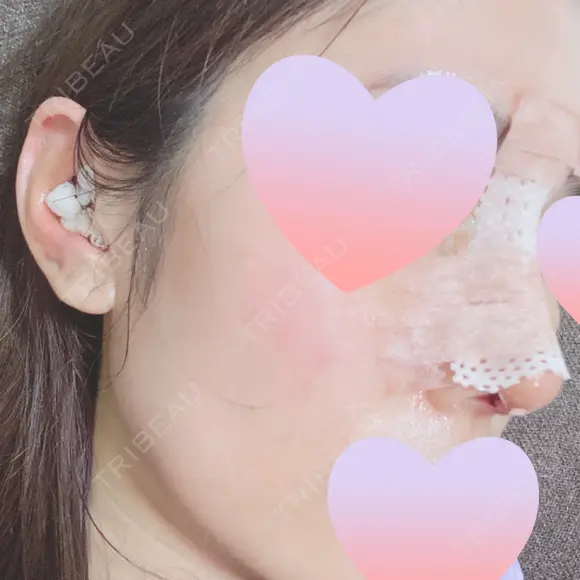 隆鼻術 / 鼻尖形成（切開） / 鼻中隔延長（切開） / 軟骨移植 / 骨切幅寄せ / 真皮移植 表参道スキンクリニック 大阪院 DAY 3 メイン用