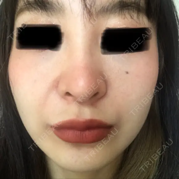 ピコレーザートーニング（美白・肝斑） B-LINE CLINIC 池袋院 DAY 8 メイン用