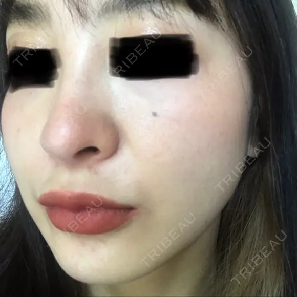 ピコレーザートーニング（美白・肝斑） B-LINE CLINIC 池袋院 DAY 8 メイン用