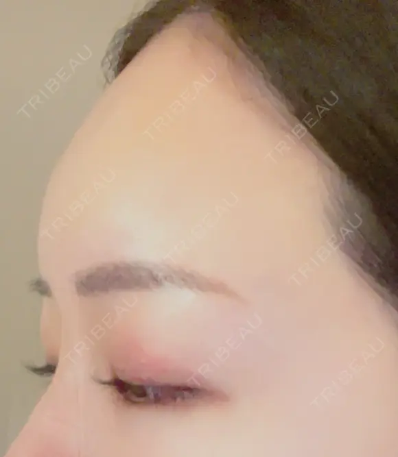 肌ヒアルロン酸注入（たるみ・シワ改善） 湘南美容クリニック 宇都宮院 DAY 9 メイン用