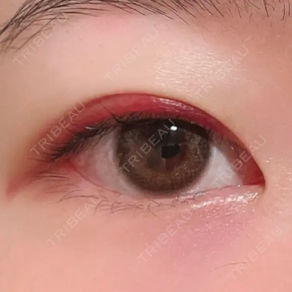 二重埋没 湘南美容クリニック 上野院 DAY 11 メイン用