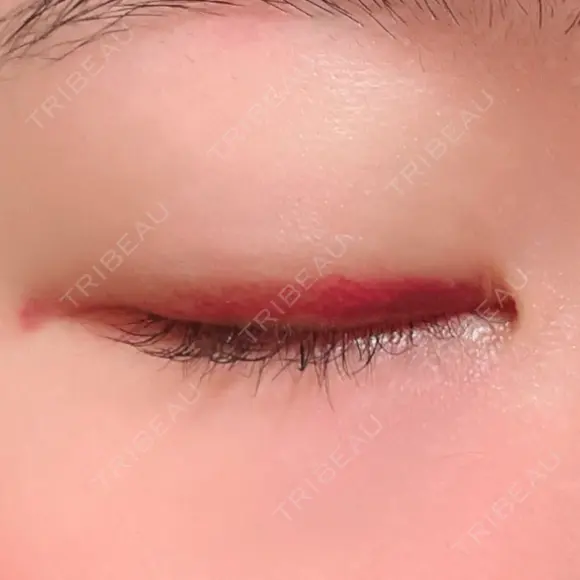 二重埋没 湘南美容クリニック 上野院 DAY 11 メイン用