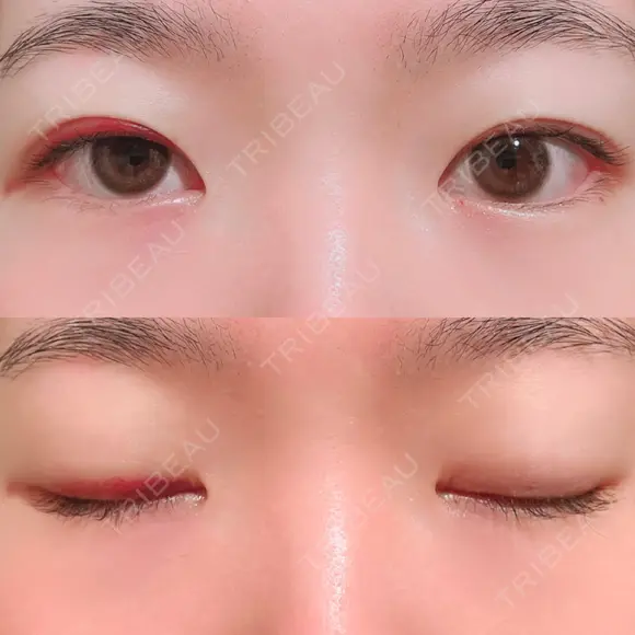 二重埋没 湘南美容クリニック 上野院 DAY 11 メイン用