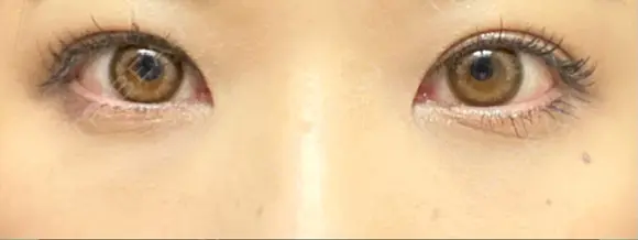 クマ治療 / 下まぶたの脂肪取り / 脂肪注入（肌） X CLINIC 大阪院 DAY 28 メイン用