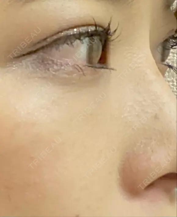 クマ治療 / 下まぶたの脂肪取り / 脂肪注入（肌） X CLINIC 大阪院 DAY 28 メイン用