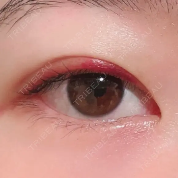 二重埋没 湘南美容クリニック 上野院 DAY 12 メイン用