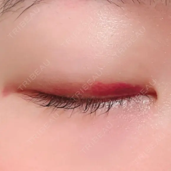 二重埋没 湘南美容クリニック 上野院 DAY 12 メイン用