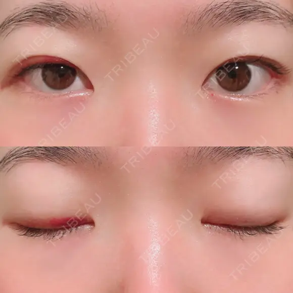 二重埋没 湘南美容クリニック 上野院 DAY 12 メイン用