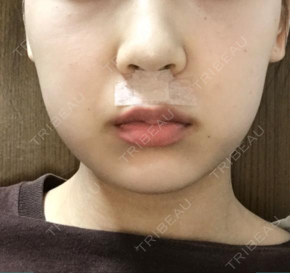 脂肪溶解注射（顔） 有楽町美容外科クリニック DAY 129 メイン用