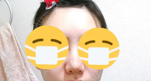 鼻尖形成（切開） / 小鼻縮小（切開） / ヒアルロン酸注入（鼻） 東京ヒルズクリニック 新宿院 DAY 5 メイン用