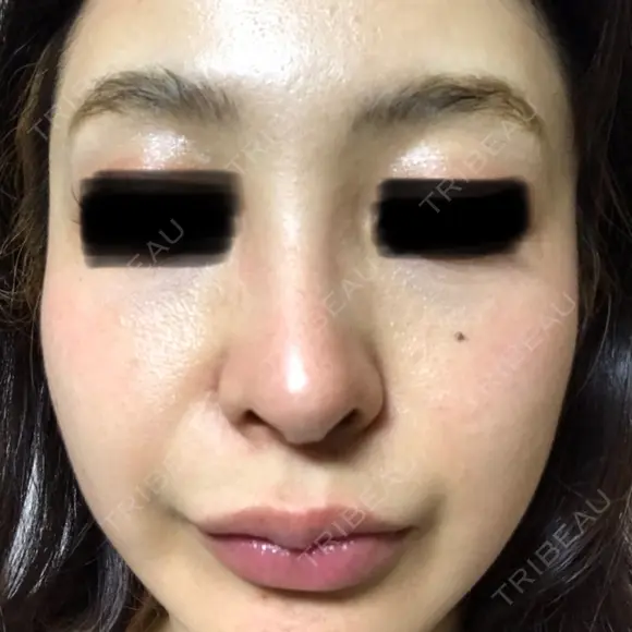 ピコレーザートーニング（美白・肝斑） B-LINE CLINIC 池袋院 AFTER メイン用