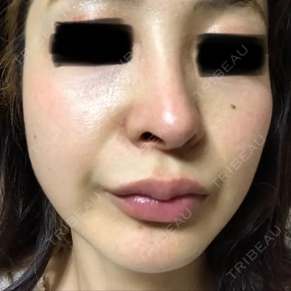 ピコレーザートーニング（美白・肝斑） B-LINE CLINIC 池袋院 DAY 10 メイン用