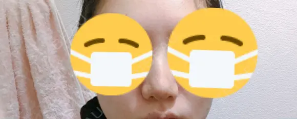 鼻尖形成（切開） / 小鼻縮小（切開） / ヒアルロン酸注入（鼻） 東京ヒルズクリニック 新宿院 DAY 6 メイン用