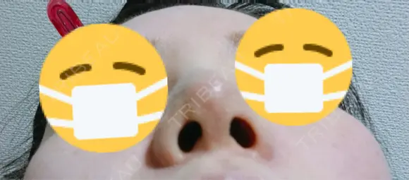 鼻尖形成（切開） / 小鼻縮小（切開） / ヒアルロン酸注入（鼻） 東京ヒルズクリニック 新宿院 DAY 6 メイン用