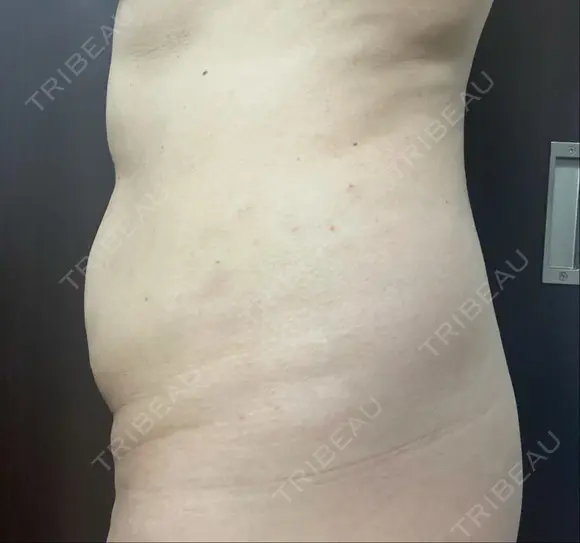 脂肪溶解注射（お腹） 渋谷美容外科クリニック 新宿院 DAY 1 メイン用