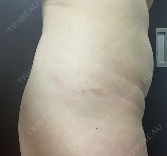 脂肪溶解注射（お腹） 渋谷美容外科クリニック 新宿院 DAY 1 メイン用