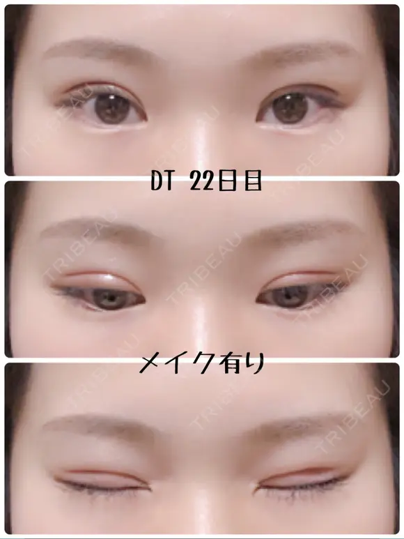 二重切開 / 上まぶたの脂肪取り 樹のひかり 形成外科・皮ふ科 DAY 22 メイン用