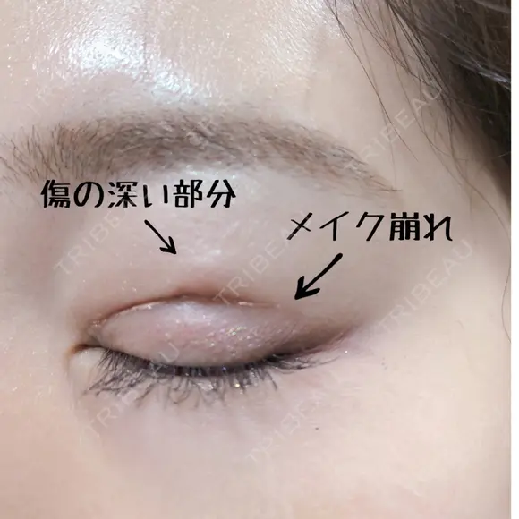 二重切開 / 上まぶたの脂肪取り 樹のひかり 形成外科・皮ふ科 DAY 22 メイン用