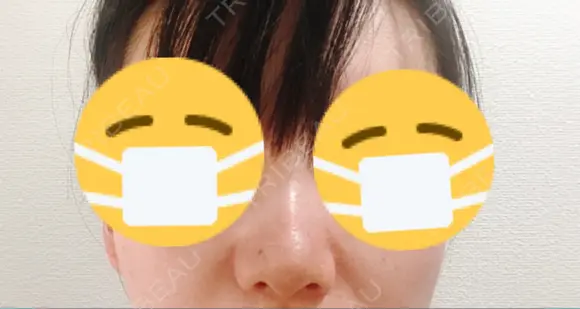 鼻尖形成（切開） / 小鼻縮小（切開） / ヒアルロン酸注入（鼻） 東京ヒルズクリニック 新宿院 DAY 7 メイン用