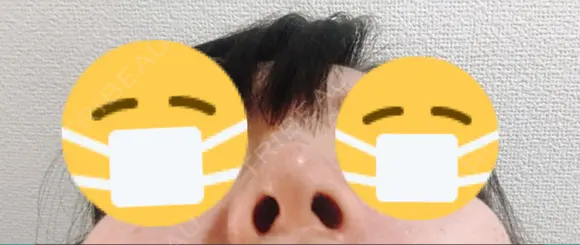 鼻尖形成（切開） / 小鼻縮小（切開） / ヒアルロン酸注入（鼻） 東京ヒルズクリニック 新宿院 DAY 7 メイン用