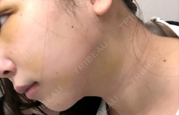 糸リフト / 脂肪吸引（顔） / ジョールファット除去 アリエル美容クリニック 大宮院 DAY 4 メイン用