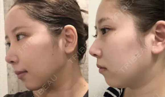 糸リフト / 脂肪吸引（顔） / ジョールファット除去 アリエル美容クリニック 大宮院 DAY 6 メイン用