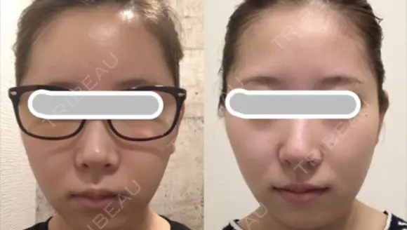 糸リフト / 脂肪吸引（顔） / ジョールファット除去 アリエル美容クリニック 大宮院 DAY 6 メイン用