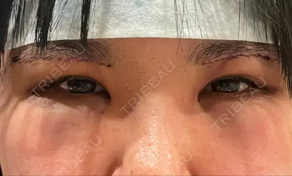脂肪吸引（顔） / 上まぶたの脂肪取り / 下まぶたの脂肪取り / 眉下切開 LIKI CLINIC KOBE DAY 0 メイン用