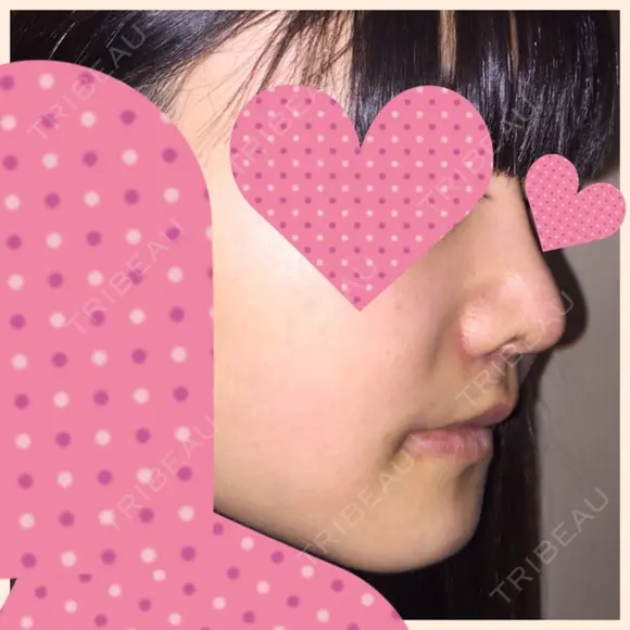 セットバック 大塚美容形成外科・歯科 大塚本院 DAY 35 メイン用