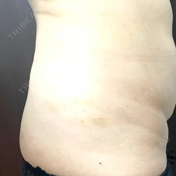 脂肪溶解注射（お腹） 渋谷美容外科クリニック 新宿院 DAY 3 メイン用