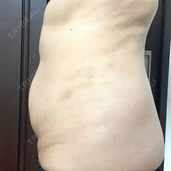 脂肪溶解注射（お腹） 渋谷美容外科クリニック 新宿院 DAY 3 メイン用