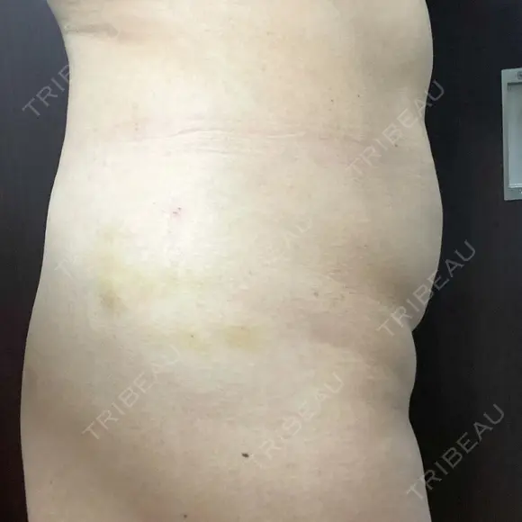 脂肪溶解注射（お腹） 渋谷美容外科クリニック 新宿院 DAY 5 メイン用